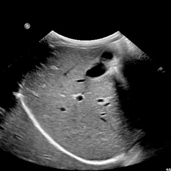 Ultrasound Upper Abdomen